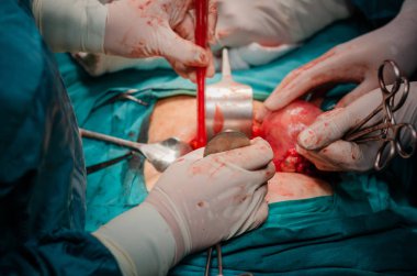 Histerektomi ameliyatı sırasında rahim makro sürükledi