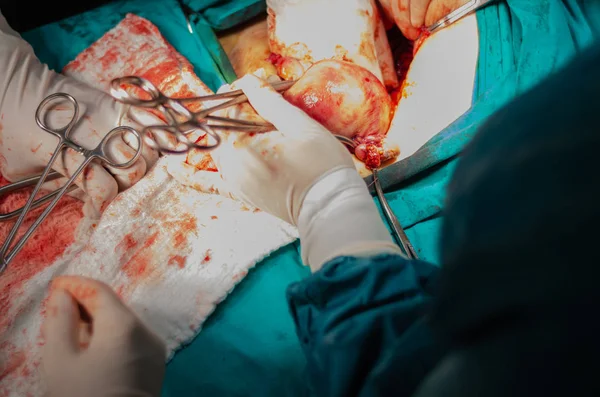 Macro Útero Arrastrado Durante Cirugía Histerectomía — Foto de Stock
