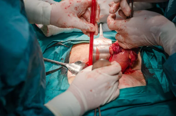 Cirujano Saca Útero Del Cuerpo Sujetándolo Con Herramientas Quirúrgicas Cerca —  Fotos de Stock