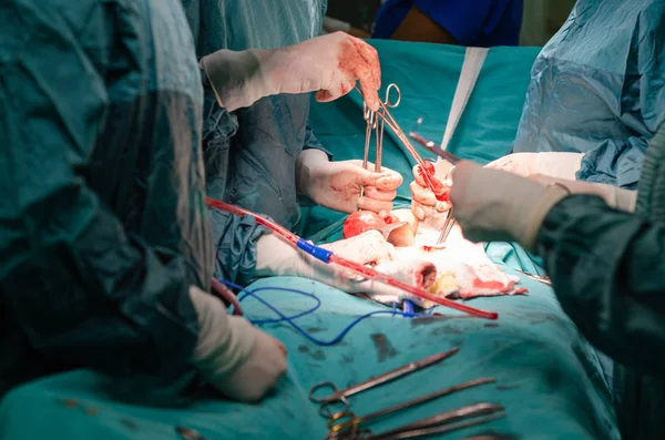 Surgeon Pulls Uterus Out Body Holding Surgical Tools Close Hysterectomy — Stock Photo, Image