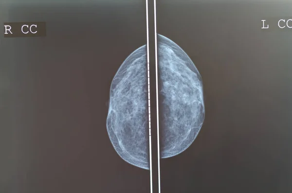 mamografi meme tarama x-ray görüntü