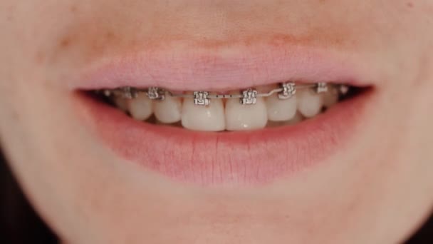 Жіноча посмішка з зубними брекетами — стокове відео