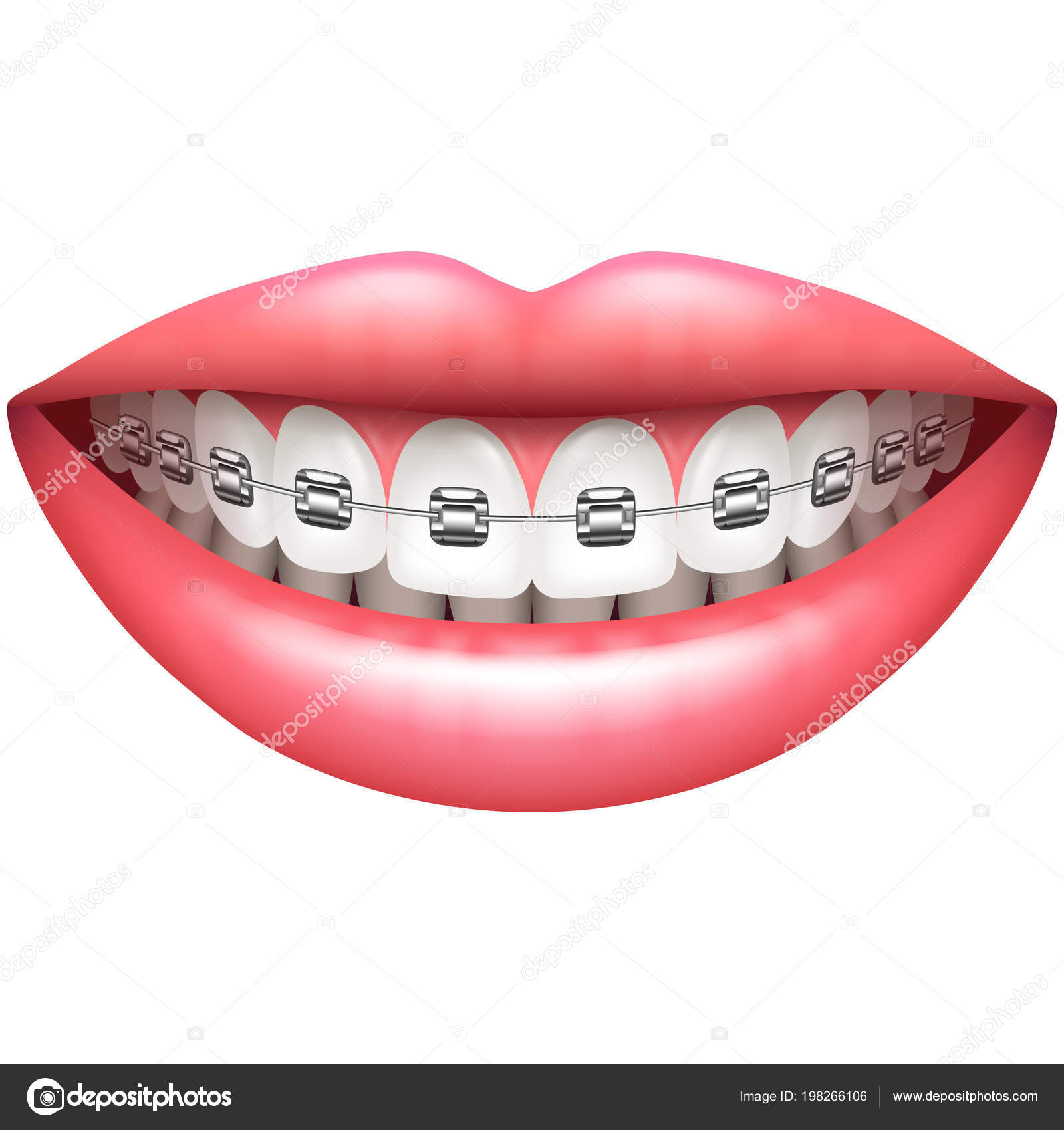 Ortodoncia brackets imágenes de stock de arte vectorial | Depositphotos Ortodoncia brackets imágenes de stock de arte vectorial | Depositphotos