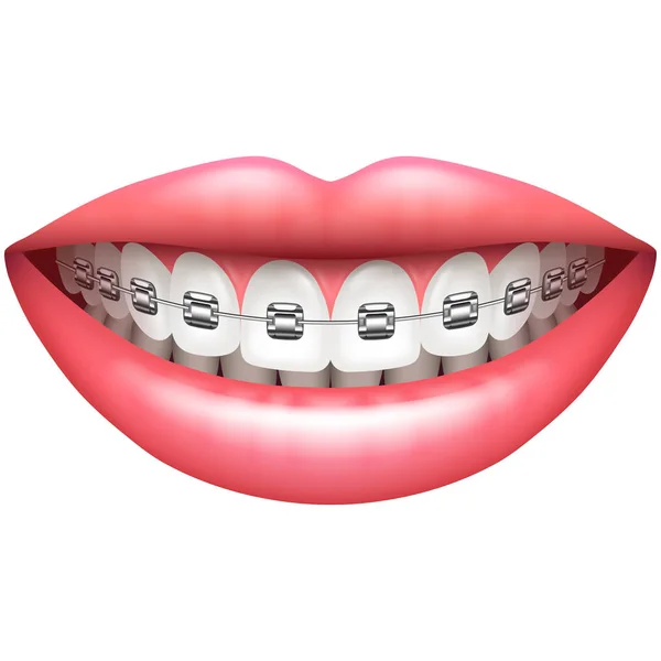 Güzel Kadın Gülümseme Üzerinde Beyaz Izole Diş Telleri Ile Diş — Stok Vektör