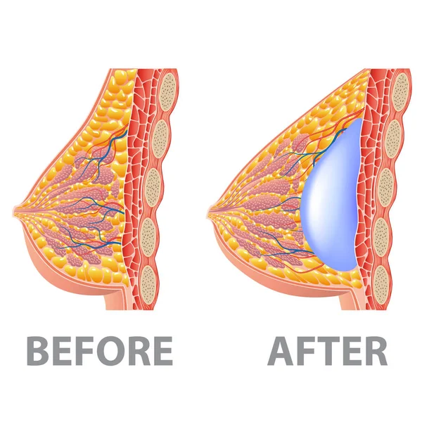 乳房植入术前后分离的白色照片 现实矢量图 — 图库矢量图片