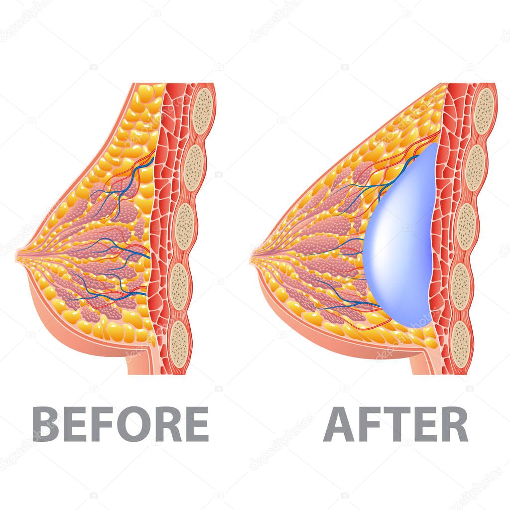Breast implant before and after isolated on white photo-realistic vector illustration