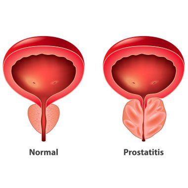 Prostatitis normal and inflamed prostate isolated vector photo-realistic illustration clipart
