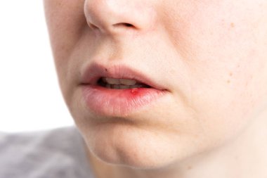 Pustule ulceration or aphtae on woman lip as painful oral mouth spot concept clipart