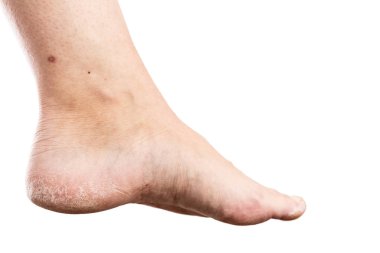 Kadın ayak beyaz arka plan üzerinde izole dermatit veya Dermatoloji kavram olarak kırık topuk ile