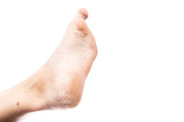 Kadın çıplak ayak kırık topuk ve sorun kavramı Nasıra gibi ayak parmakları ile