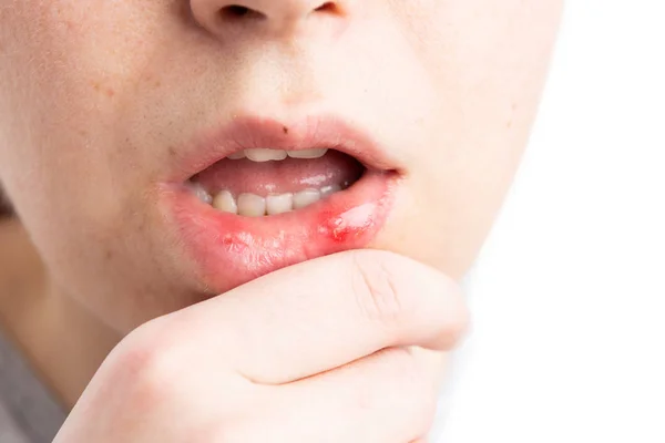 Aphtha Onderste Lip Van Vrouw Als Medisch Ongemak Vrouwelijke Stomatitis — Stockfoto