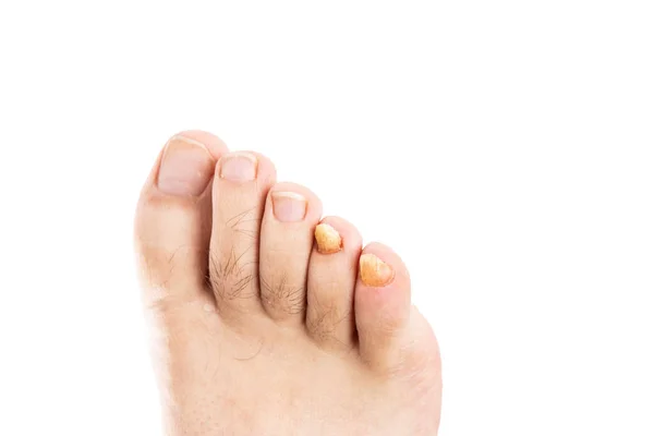 Male Toenails Fungal Infection Isolated White Background Copyspace — Stock Photo, Image