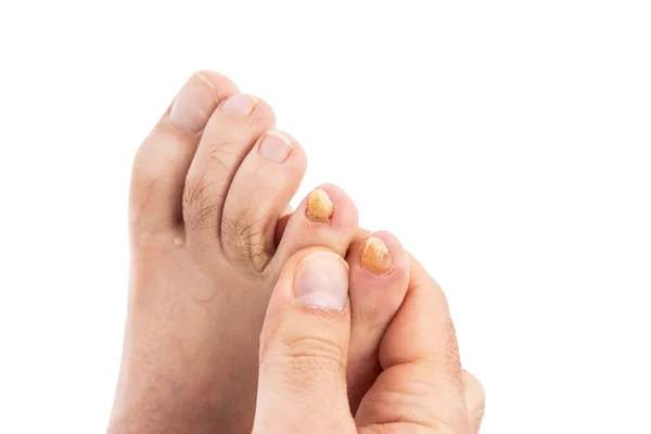 Candida ve beyaz arka plan ile boşaltmak izole mantar sorunları nedeniyle çirkin erkek ayak tırnaklarını