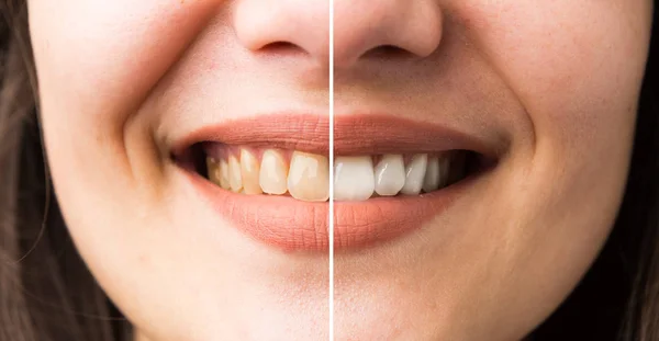 Woman Smile Bleaching Perfect White Denture Concept — Stock Photo, Image