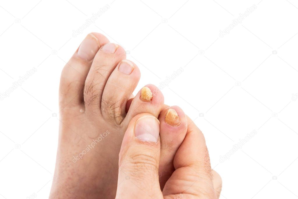 Ugly male toenails because of candida and fungal problems isolated on white background with copyspace