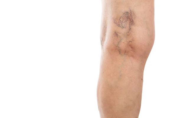 Fechar de varizes atrás de joelho — Fotografia de Stock
