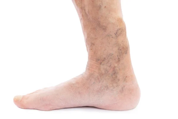 Primer plano del pie y la pierna con varicosa — Foto de Stock