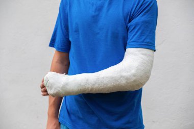 Kırık kollu, tıbbi alçı sıva sıyrıklı adam. Spor kazasından sonra bilek, kol, dirsek kaplama fiberglas döküm, beyaz izole