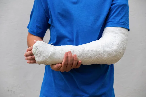 Homme avec un bras cassé enveloppé de plâtre médical coulé. Moule en fibre de verre couvrant le poignet, le bras, le coude après un accident sportif, isolé sur blanc — Photo