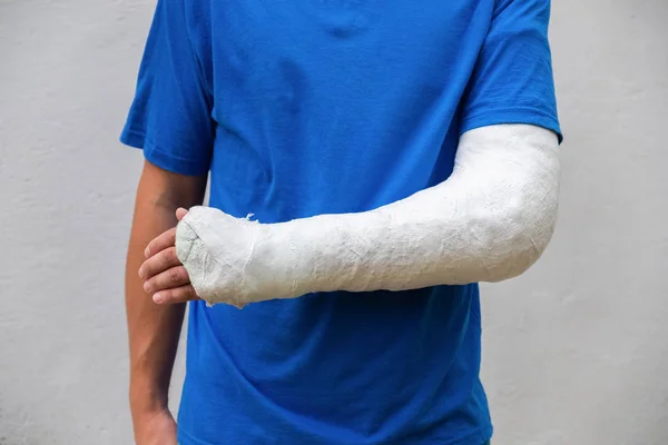 Homme avec un bras cassé enveloppé de plâtre médical coulé. Moule en fibre de verre couvrant le poignet, le bras, le coude après un accident sportif, isolé sur blanc — Photo