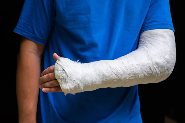 Mann mit gebrochenem Arm mit Gips umwickelt. Fiberglas-Guss, der Handgelenk, Arm, Ellbogen nach einem Sportunfall bedeckt, isoliert auf schwarz — Stockfoto