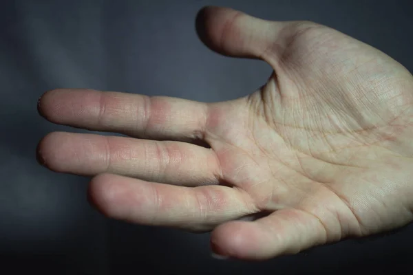 Mão Com Calos Pequenos Depois Uma Sessão Difícil Ginásio Escalada — Fotografia de Stock