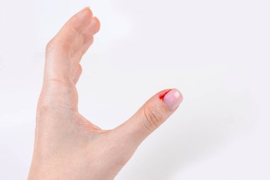 Bleeding hangnail closeup female hand injury. Bad habits, biting and ripping off hangnails on fingernails onw hite background clipart