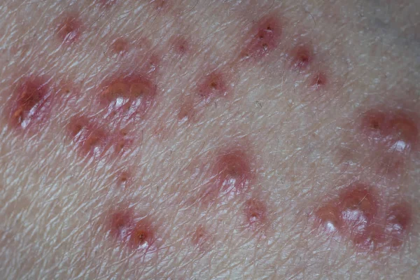 Vírus herpes zoster infectado pela pele . — Fotografia de Stock