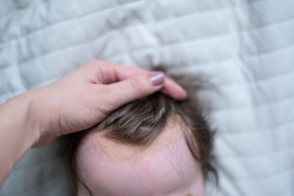 Seborrheic dermatitis on head of the baby. Newborn with seborrhea, close-up.