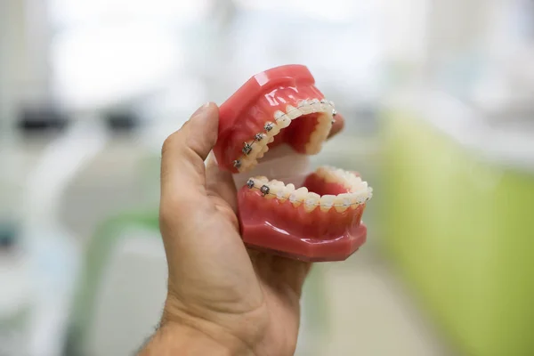 치아 교정 치과 교육 모델 턱 절반 세라믹 고 절반 금속 브래킷 치아와 턱 모델. — 스톡 사진