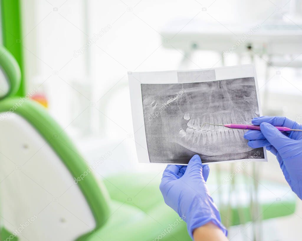 Female dentist holding a dental x-ray. The nurse holds an x-ray from the human jaw and points to a tooth with caries. Periodontists office.