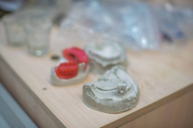 İmplantlar için insan dişi kalıpları. Seramik çene. Diş teknisyenleri için atölye.