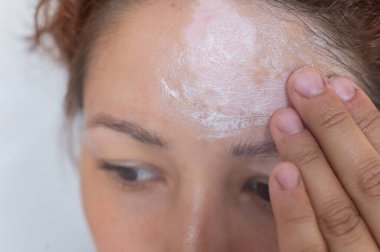 Vitiligo. Alnında deri pigmentasyonu olmayan bir kadının yakın plan portresi. Kız, yüz derisindeki beyaz bir noktaya güneş kremi sürüyor. Otoimmün hastalık.