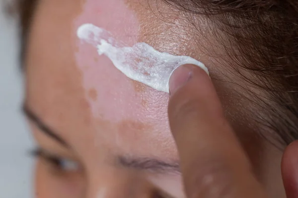 Vitiligo. Um retrato de perto de uma mulher sem pigmentação da pele na testa. Menina esfrega protetor solar em uma mancha branca na pele do rosto. Doença auto-imune. — Fotografia de Stock