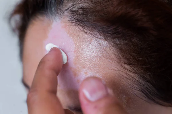 Vitiligo. Een close-up portret van een vrouw zonder huidpigmentatie op haar voorhoofd. Meisje smeert zonnebrandcrème op een witte vlek op de huid van het gezicht. Auto-immuunziekte. — Stockfoto