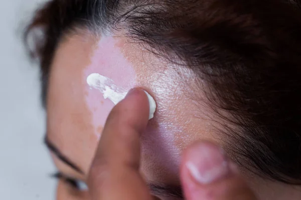 Vitiligo. Een close-up portret van een vrouw zonder huidpigmentatie op haar voorhoofd. Meisje smeert zonnebrandcrème op een witte vlek op de huid van het gezicht. Auto-immuunziekte. — Stockfoto