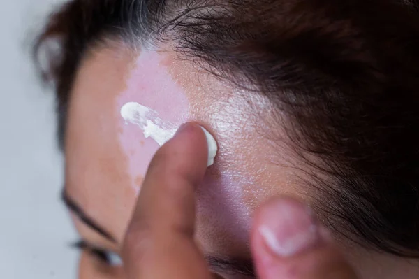 Vitiligo. A close-up portrait of a woman with no skin pigmentation on her forehead. Girl smears sunscreen on a white spot on the skin of the face. Autoimmune disease.