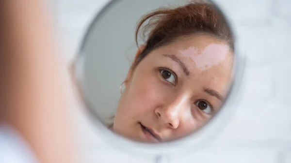 Una mujer con vitiligo se mira en el espejo. Reflexión en un espejo de mesa de una chica con una mancha blanca en la frente. Enfermedad autoinmune. Falta de pigmentación de la piel. — Foto de Stock