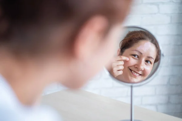 Una mujer con vitiligo se mira en el espejo. Reflexión en un espejo de mesa de una chica con una mancha blanca en la frente. Enfermedad autoinmune. Falta de pigmentación de la piel. — Foto de Stock