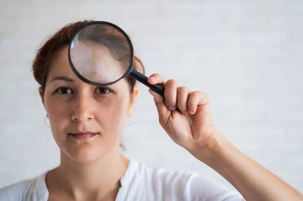 Vitiligo. Retrato de uma mulher bonita com falta de pigmentação da pele na testa com uma lupa nas mãos. Uma rapariga com uma mancha branca no rosto tem uma lupa. Doença auto-imune . — Fotografia de Stock