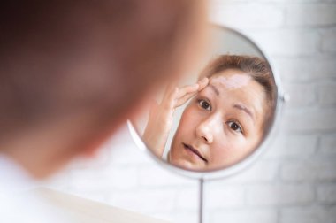 Vitiligo 'su olan bir kadın aynaya bakar. Masadaki yansıma alnında beyaz bir leke olan bir kız. Otoimmün hastalık. Cilt pigmentasyonu eksikliği.