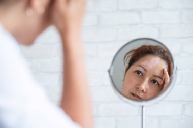 Vitiligo 'su olan bir kadın aynaya bakar. Masadaki yansıma alnında beyaz bir leke olan bir kız. Otoimmün hastalık. Cilt pigmentasyonu eksikliği.