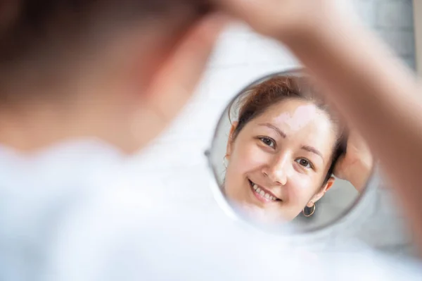 Una mujer con vitiligo se mira en el espejo. Reflexión en un espejo de mesa de una chica con una mancha blanca en la frente. Enfermedad autoinmune. Falta de pigmentación de la piel. — Foto de Stock