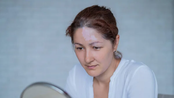 Retrato de uma mulher caucasiana com vitiligo. Uma rapariga com uma mancha de pigmento branco na testa olha-se ao espelho. Uma doença autoimune que afeta a pele. — Fotografia de Stock