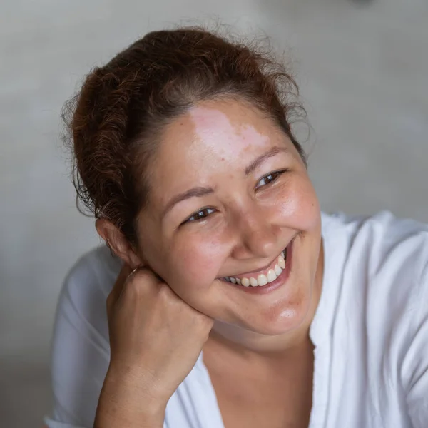 Porträt einer lächelnden Frau mit Vitiligo-Krankheit. — Stockfoto