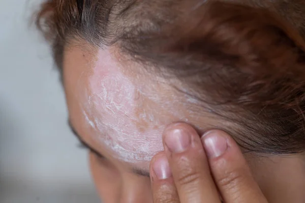 Vitiligo. Um retrato de perto de uma mulher sem pigmentação da pele na testa. Menina esfrega protetor solar em uma mancha branca na pele do rosto. Doença auto-imune. — Fotografia de Stock