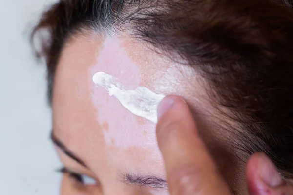 Vitiligo. Um retrato de perto de uma mulher sem pigmentação da pele na testa. Menina esfrega protetor solar em uma mancha branca na pele do rosto. Doença auto-imune. — Fotografia de Stock