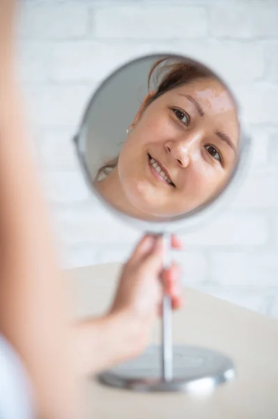 Una mujer con vitiligo se mira en el espejo. Reflexión en un espejo de mesa de una chica con una mancha blanca en la frente. Enfermedad autoinmune. Falta de pigmentación de la piel. — Foto de Stock