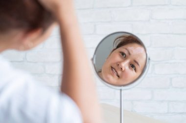 Vitiligo 'su olan bir kadın aynaya bakar. Masadaki yansıma alnında beyaz bir leke olan bir kız. Otoimmün hastalık. Cilt pigmentasyonu eksikliği.