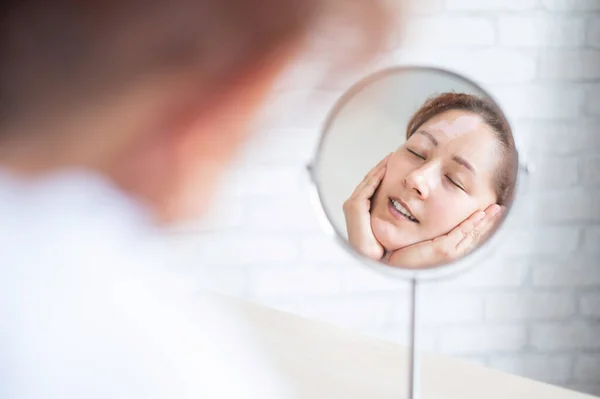 Una mujer con vitiligo se mira en el espejo. Reflexión en un espejo de mesa de una chica con una mancha blanca en la frente. Enfermedad autoinmune. Falta de pigmentación de la piel. — Foto de Stock
